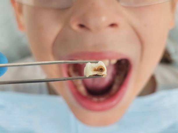 Best Emergency Tooth Extraction in Stacy, MN